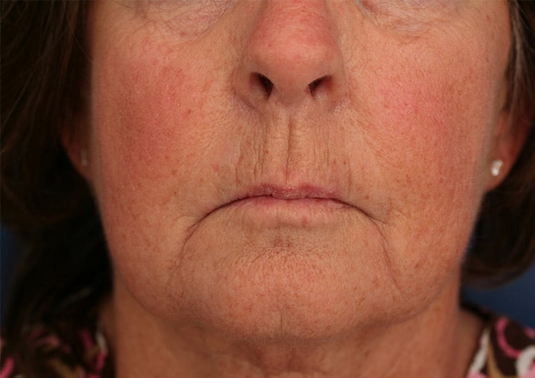 Before Image: NL and Lip lines Perlane and Restylane - front