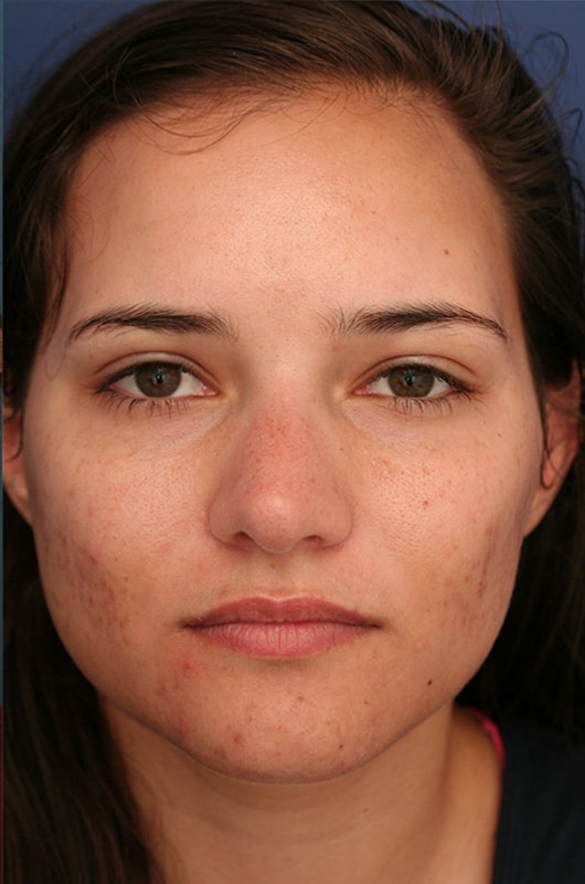 After Image: Non-surgical Nose Lyft - front