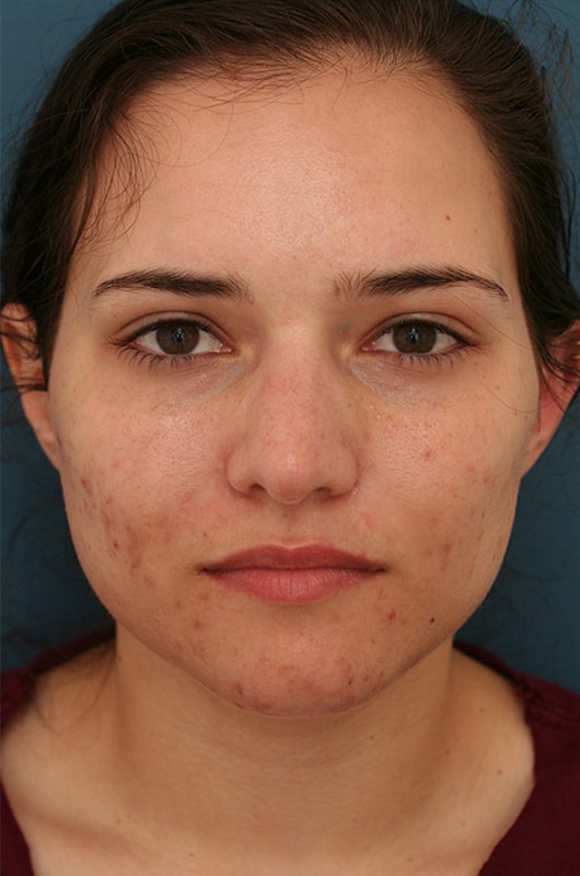 Before Image: Non-surgical Nose Lyft - front