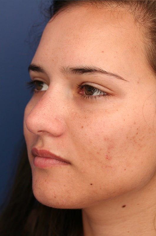 After Image: Non-surgical Nose Lyft - left-front-oblique