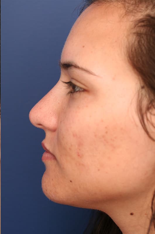 After Image: Non-surgical Nose Lyft - left-side