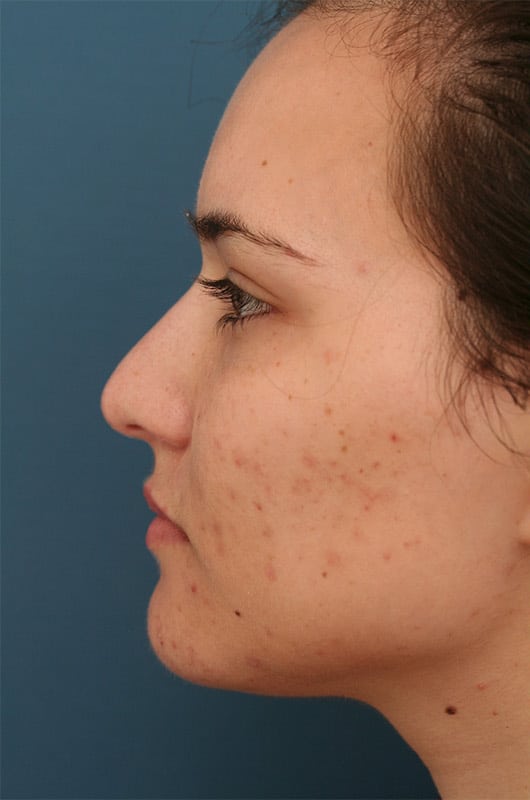 Before Image: Non-surgical Nose Lyft - left-side