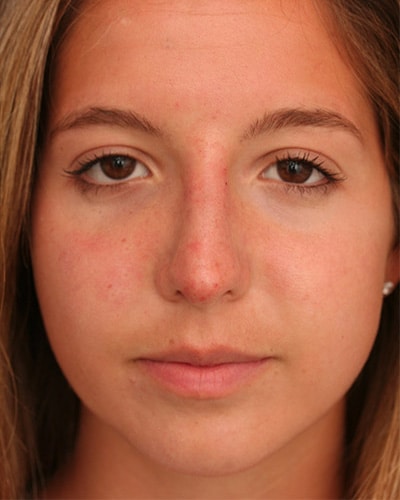 After Image: Non-surgical – Nose - front