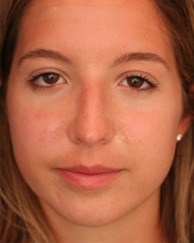 Before Image: Non-surgical – Nose - front