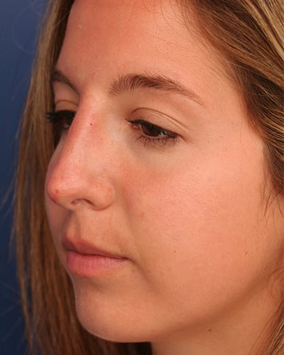 Before Image: Non-surgical – Nose - front