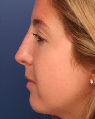 After Image: Non-surgical – Nose - left-side