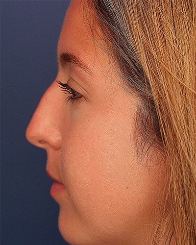 Before Image: Non-surgical – Nose - left-side