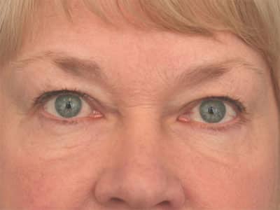 After Image: Non-surgical – Eyes and Lips - front