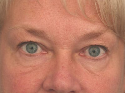 Before Image: Non-surgical – Eyes and Lips - front