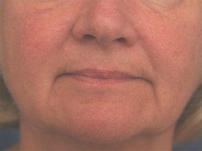 Before Image: Non-surgical – Eyes and Lips - front