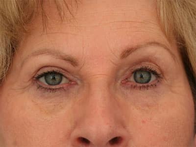 After Image: Non-surgical – Eyes - front