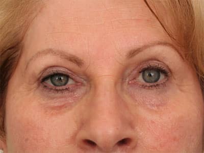 Before Image: Non-surgical – Eyes - front
