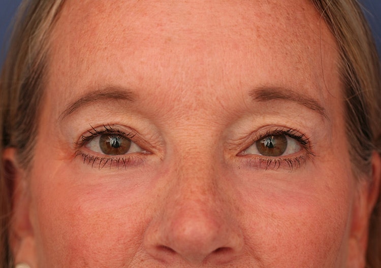 After Image: Eyelid Surgery - front