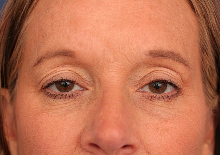 Before Image: Eyelid Surgery - front