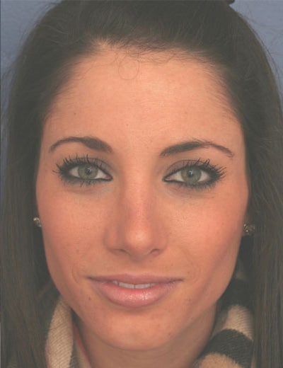 After Image: Rhinoplasty - front