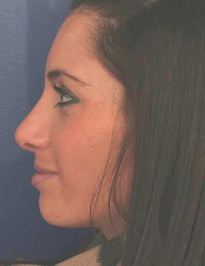 After Image: Rhinoplasty - left-side