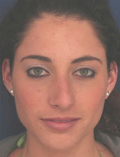 Before Image: Rhinoplasty - front