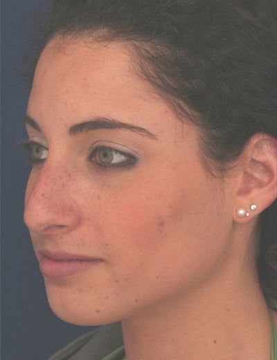 Before Image: Rhinoplasty - left-front-oblique