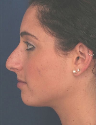 Before Image: Rhinoplasty - left-side