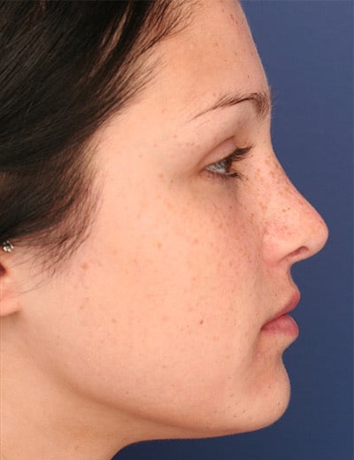 After Image: Rhinoplasty - right-side