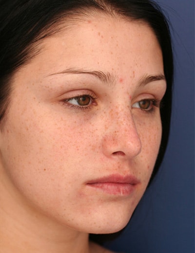 After Image: Rhinoplasty - right-front-oblique