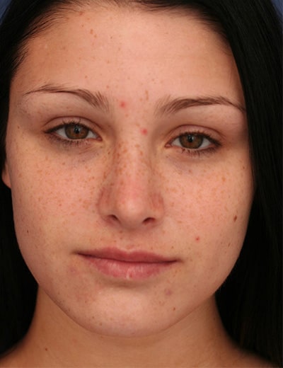 After Image: Rhinoplasty - front
