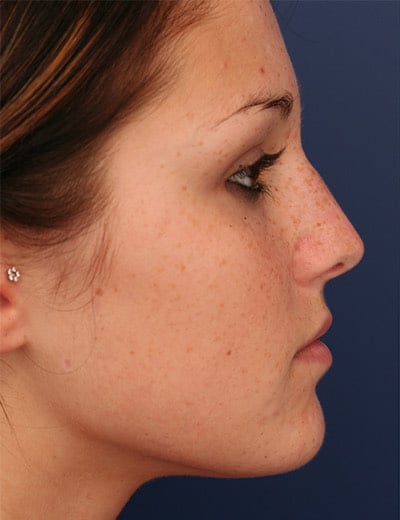 Before Image: Rhinoplasty - right-side
