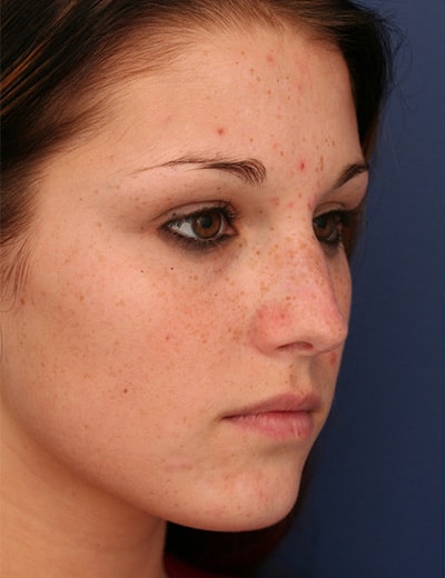Before Image: Rhinoplasty - right-front-oblique