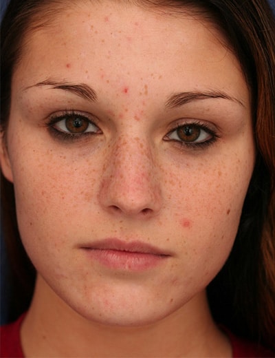 Before Image: Rhinoplasty - front