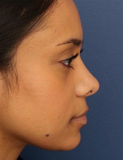 After Image: Ethnic Rhinoplasty - right-side