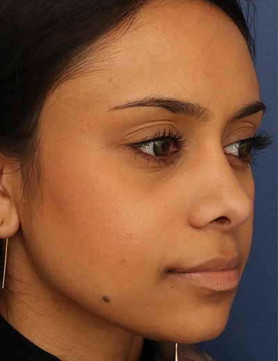 After Image: Ethnic Rhinoplasty - right-front-oblique