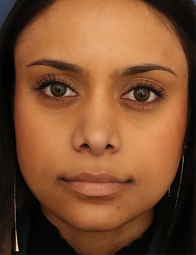 After Image: Ethnic Rhinoplasty - front