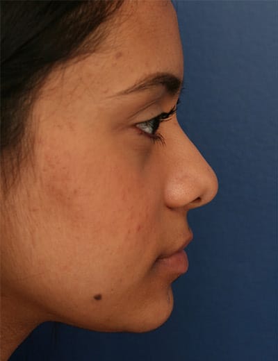 Before Image: Ethnic Rhinoplasty - right-side