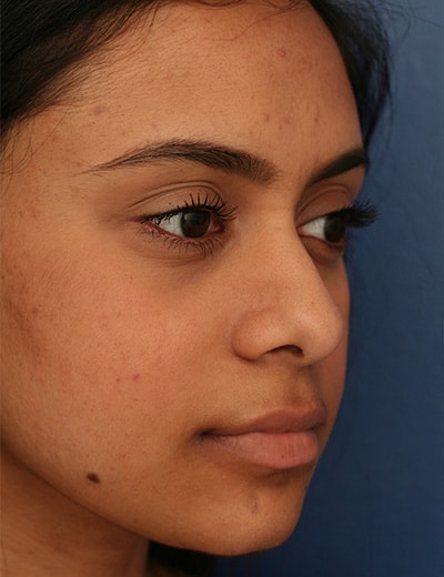 Before Image: Ethnic Rhinoplasty - right-front-oblique