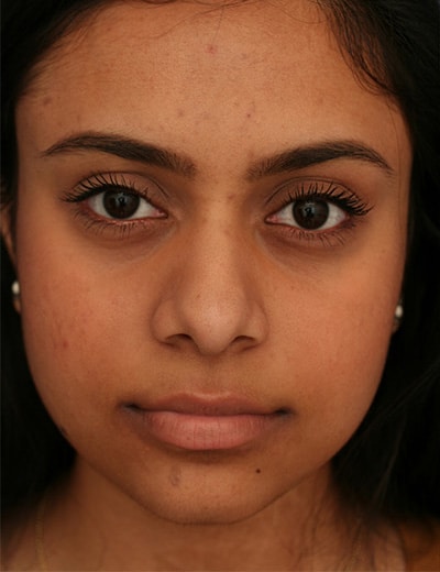 Before Image: Ethnic Rhinoplasty - front