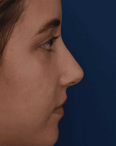 After Image: Non-Surgical Rhinoplasty - right-side