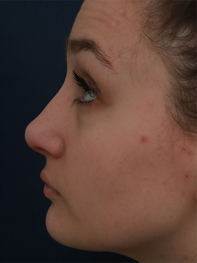 After Image: Non-Surgical Rhinoplasty - left-side