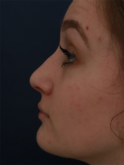 Before Image: Non-Surgical Rhinoplasty - left-side
