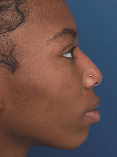 Before Image: Non-Surgical Rhinoplasty - right-side