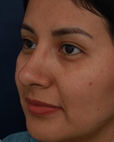 After Image: Non-Surgical Rhinoplasty - left-front-oblique