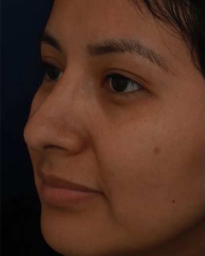 Before Image: Non-Surgical Rhinoplasty - left-front-oblique