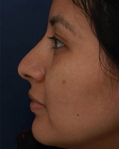 Before Image: Non-Surgical Rhinoplasty - left-side