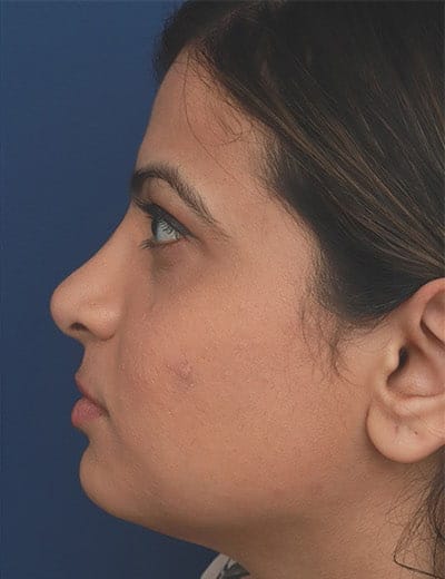 After Image: Ethnic Rhinoplasty - left-side