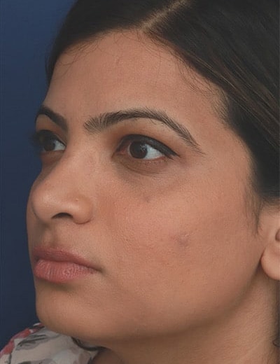 After Image: Ethnic Rhinoplasty - left-front-oblique