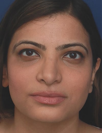 After Image: Ethnic Rhinoplasty - front