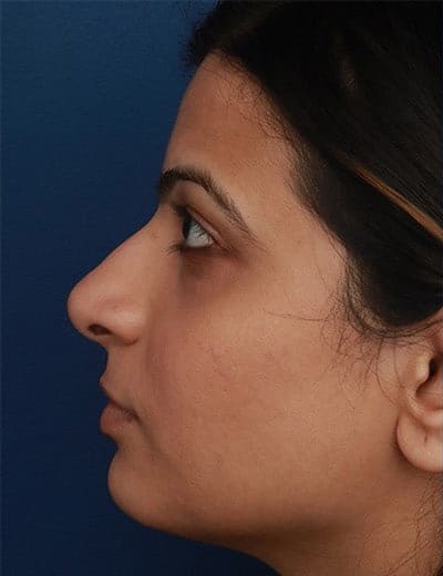 Before Image: Ethnic Rhinoplasty - left-side