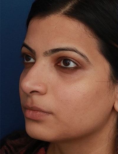 Before Image: Ethnic Rhinoplasty - left-front-oblique
