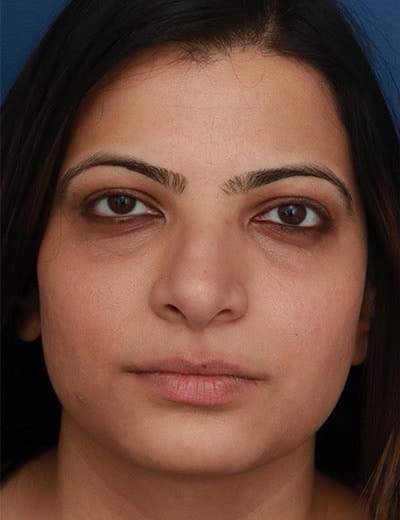 Before Image: Ethnic Rhinoplasty - front