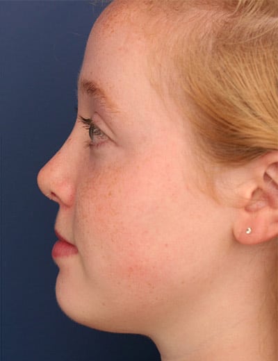 After Image: Rhinoplasty - left-side