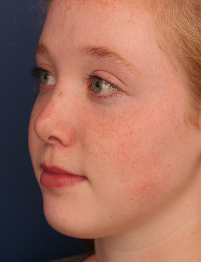 After Image: Rhinoplasty - left-front-oblique